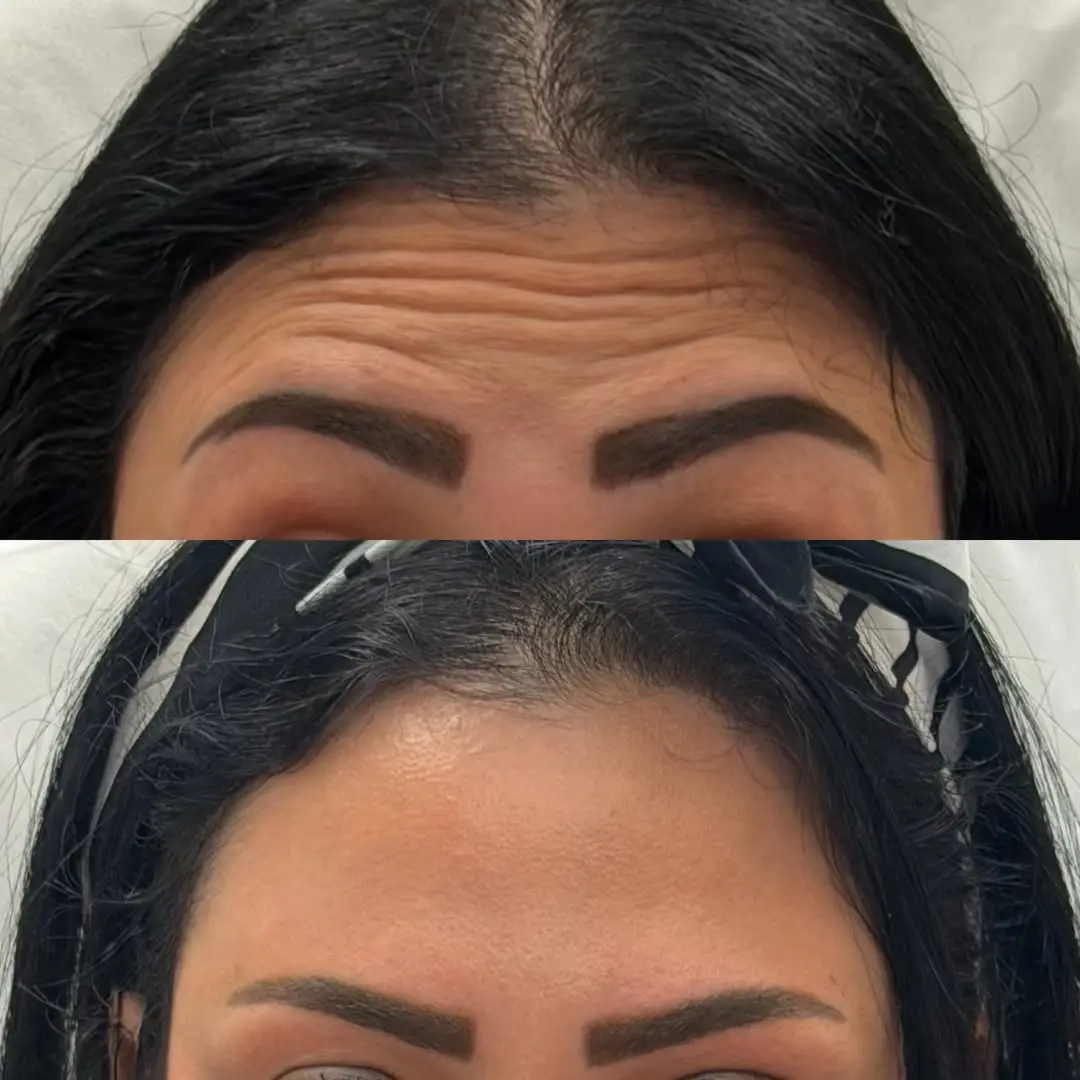 before and after eyebrows Neurotoxins image Jenelles Medspa