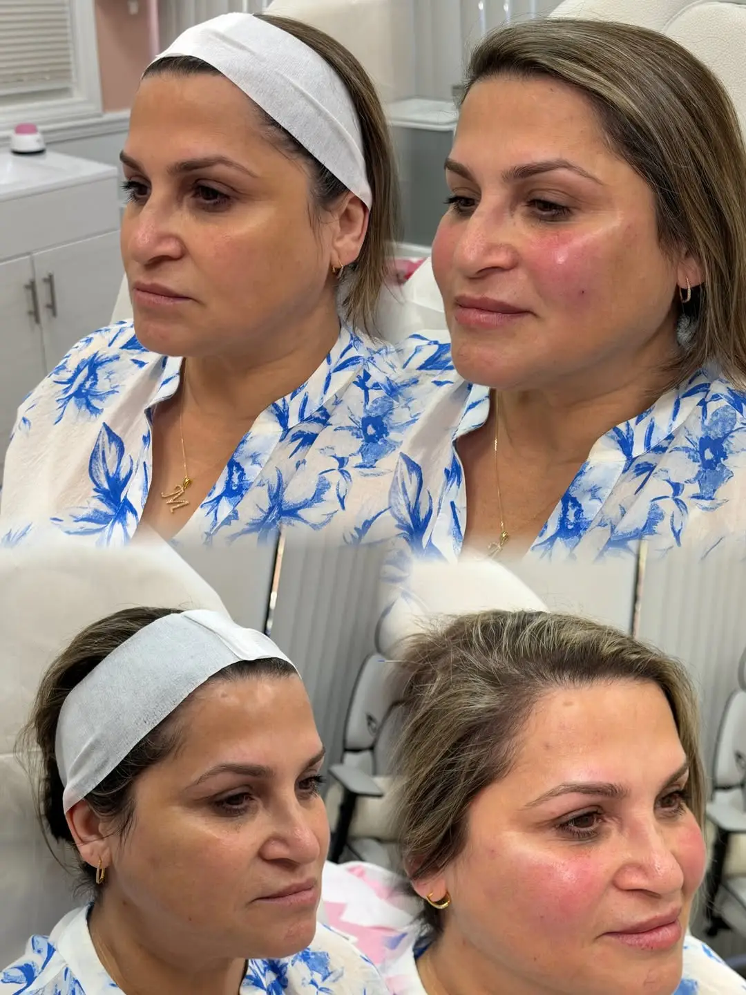 before and after EZGel PRF Jenelles Medspa
