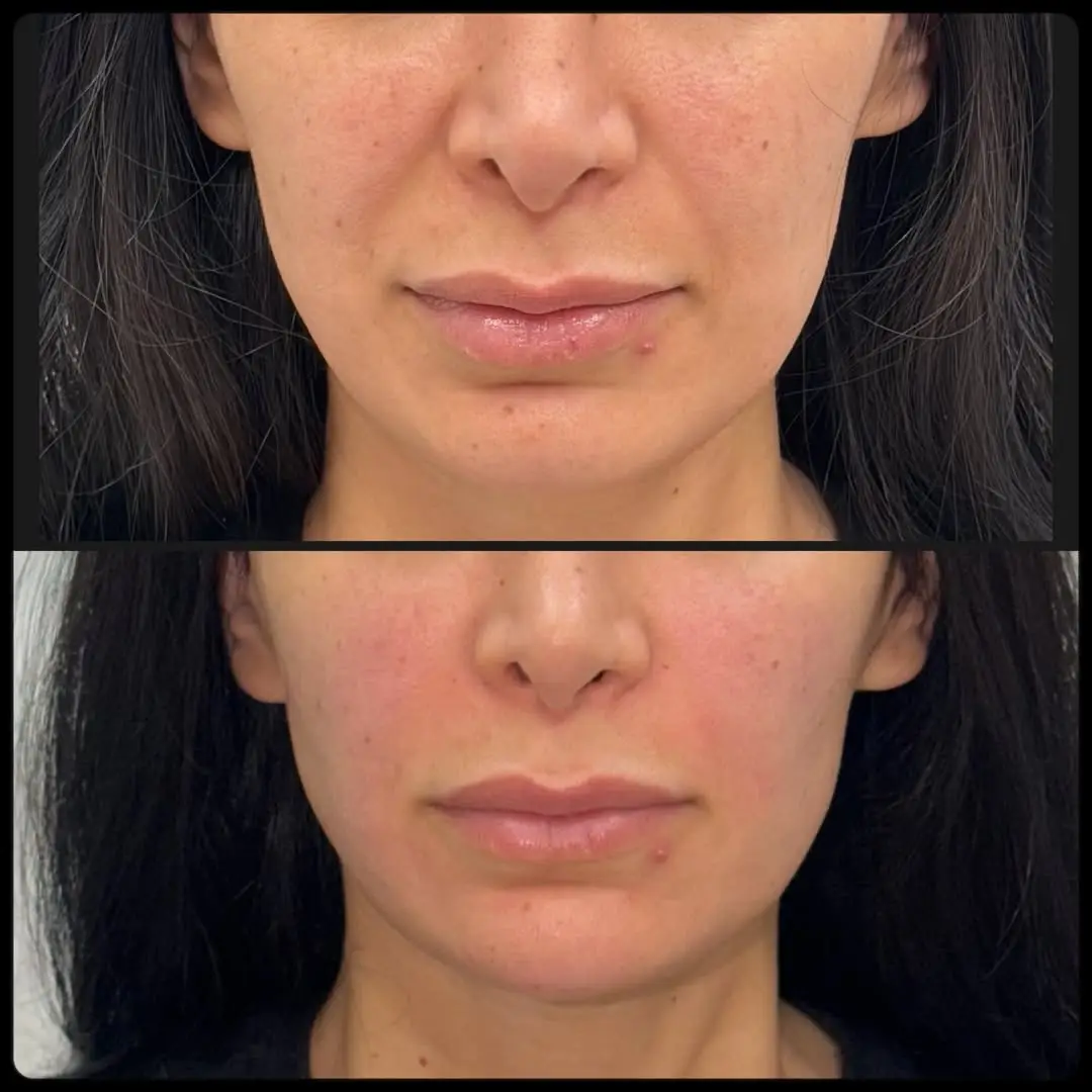 before and after Facial Fillers image four Jenelles Medspa