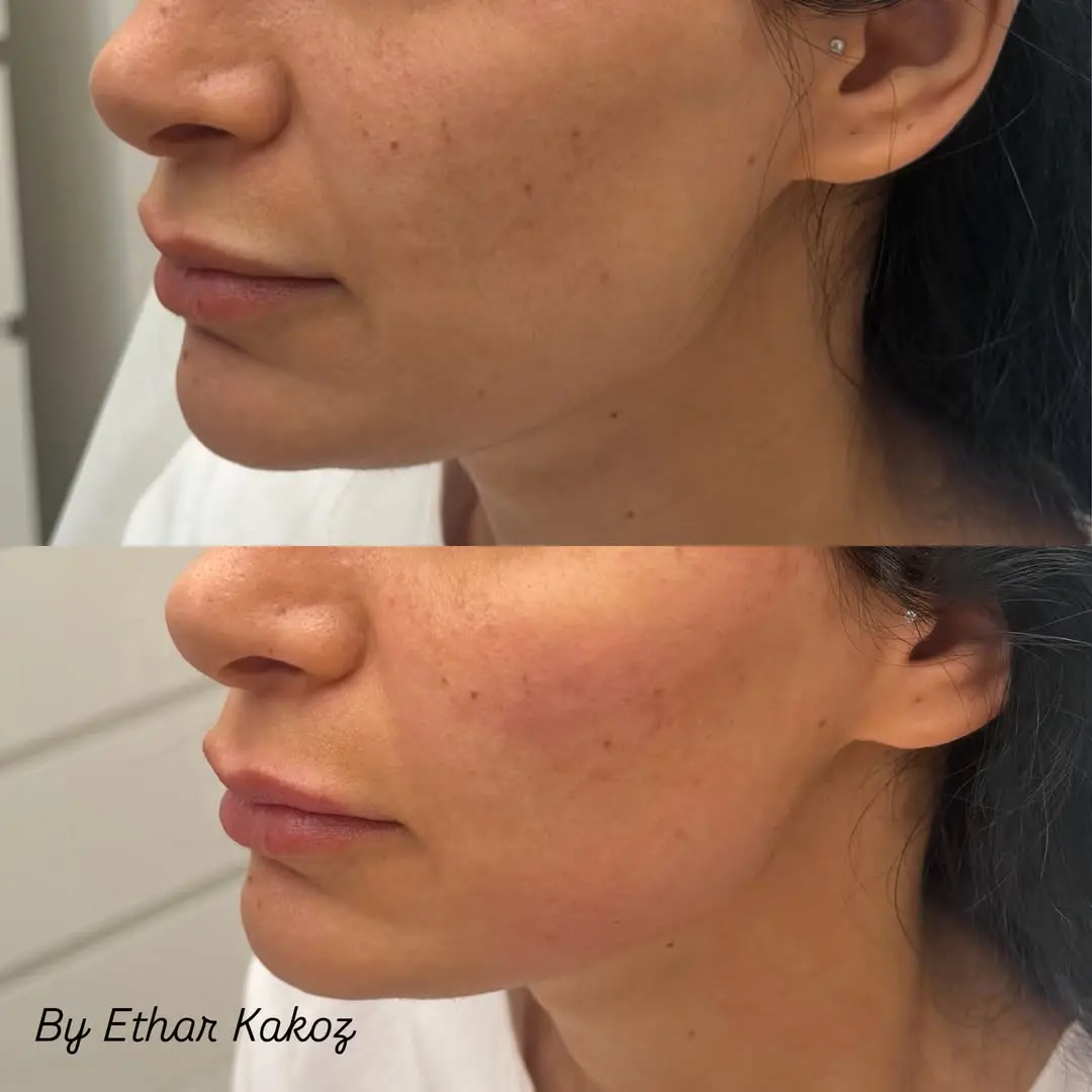 before and after Facial Fillers image-Jenelles Medspa