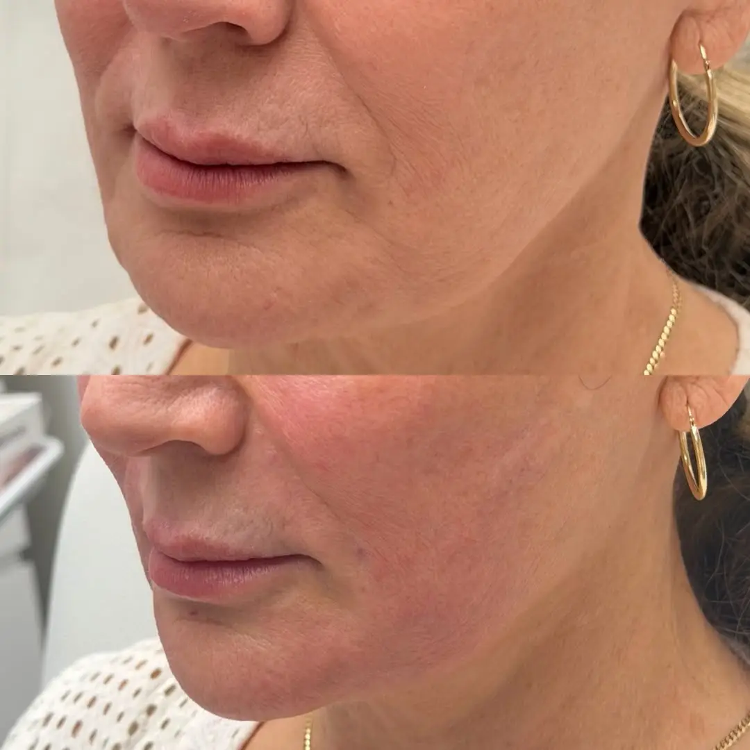 before and after Facial Fillers image one Jenelles Medspa