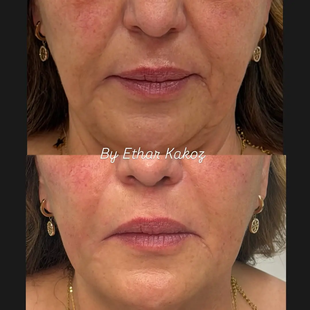 before and after Facial Filler image seven Jenelles Medspa