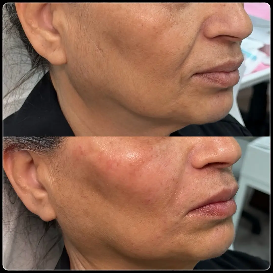 before and after Facial Fillers three image Jenelles Medspa