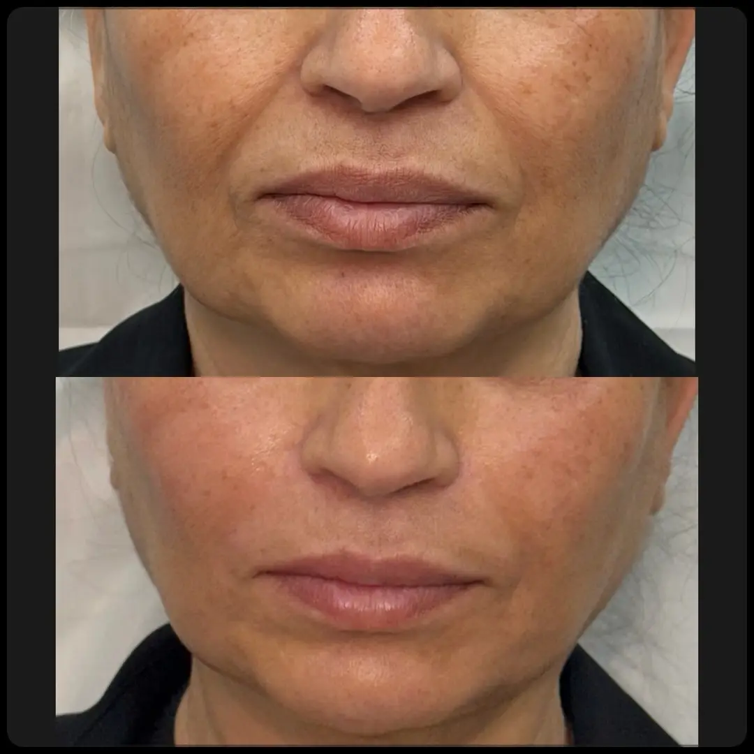 before and after Facial Fillers two Jenelles Medspa
