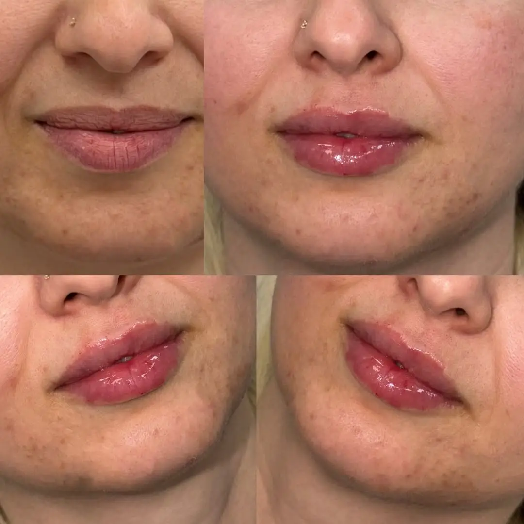 before and after Lip Fillers image-five Jenelles Medspa