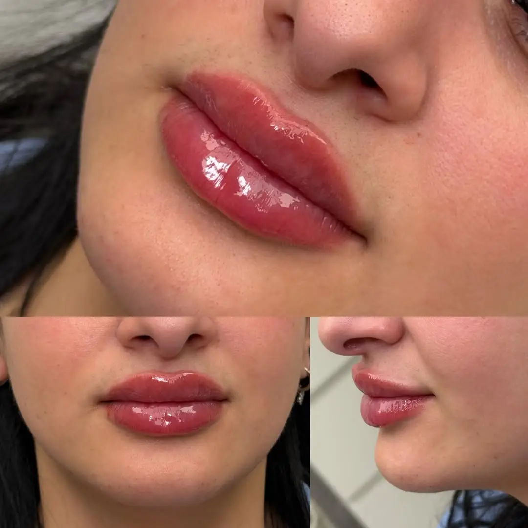 before and after Lip Fillers image four Jenelles Medspa