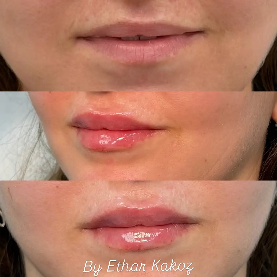 before and after Lip Fillers Image Jenelles Medspa