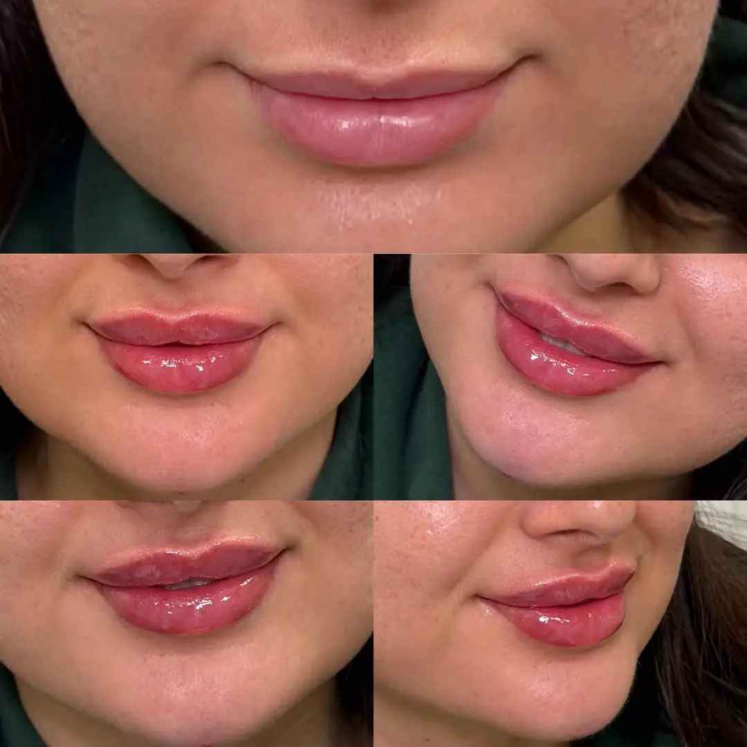 before and after Lip Fillers image one Jenelles Medspa