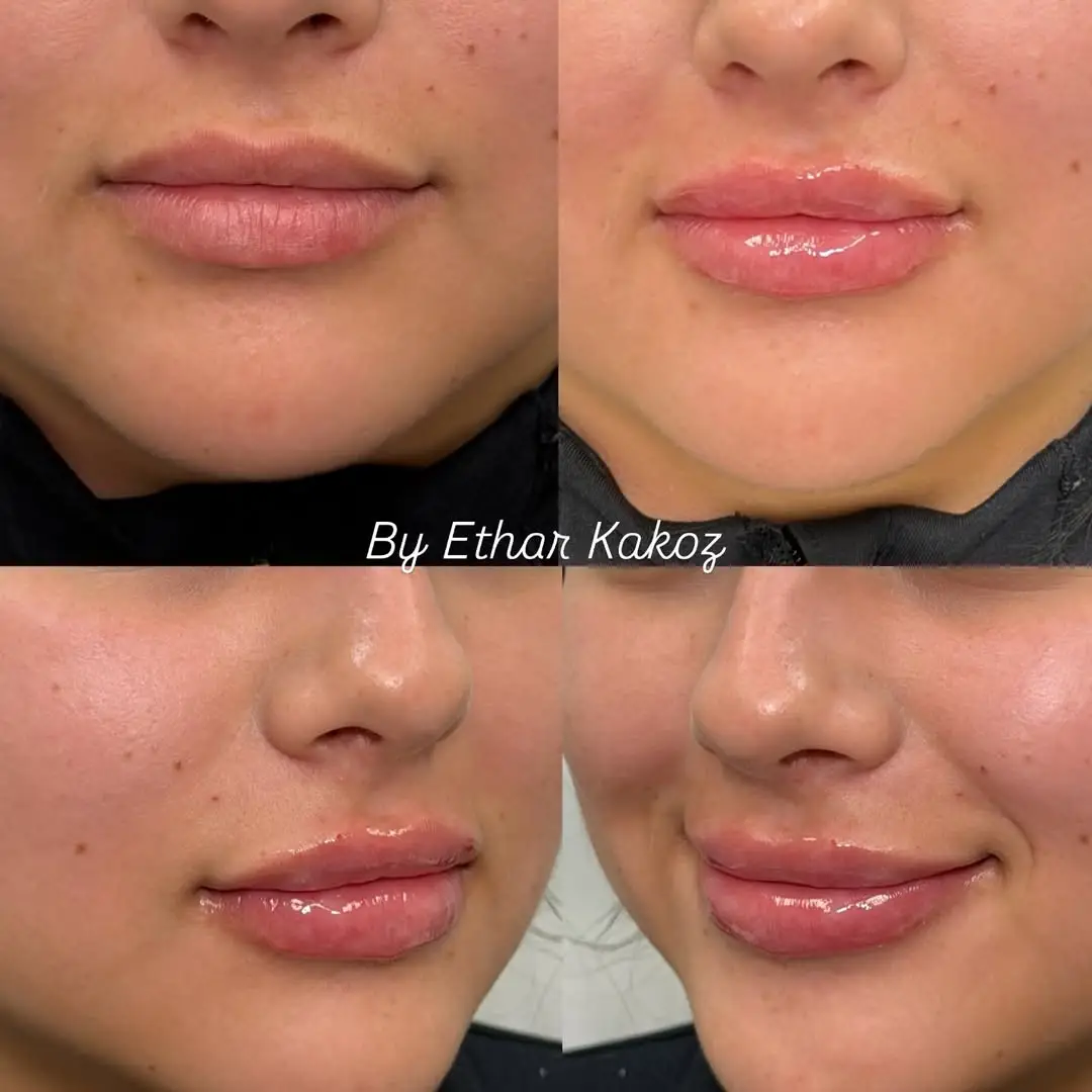 before and after Lip Fillers image six Jenelles Medspa