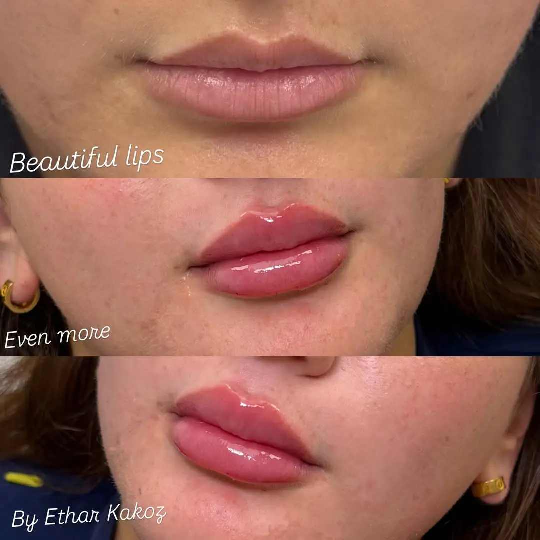 before and after Lip Fillers image three Jenelles Medspa