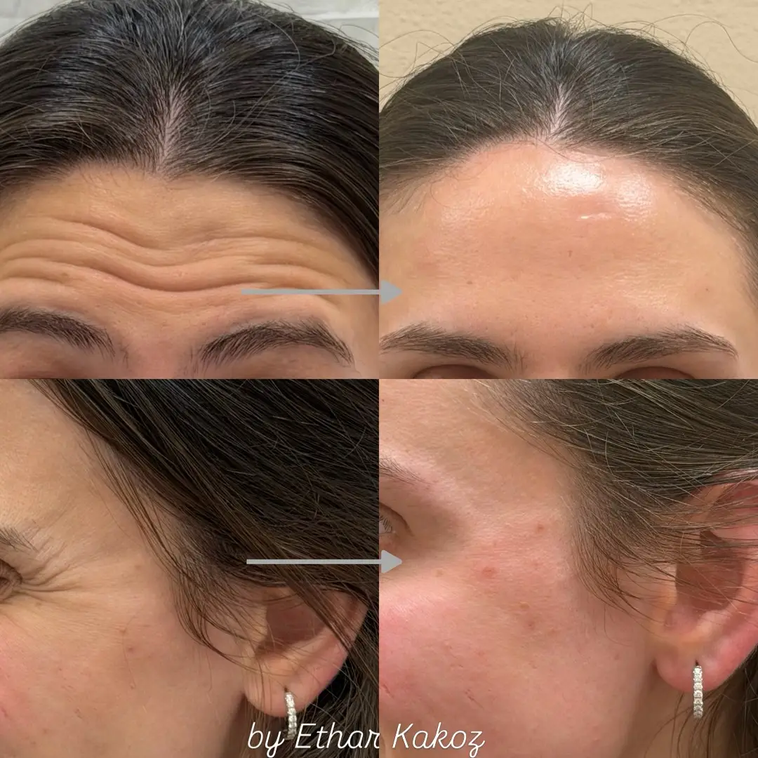 before and after Neurotoxins image Jenelles Medspa