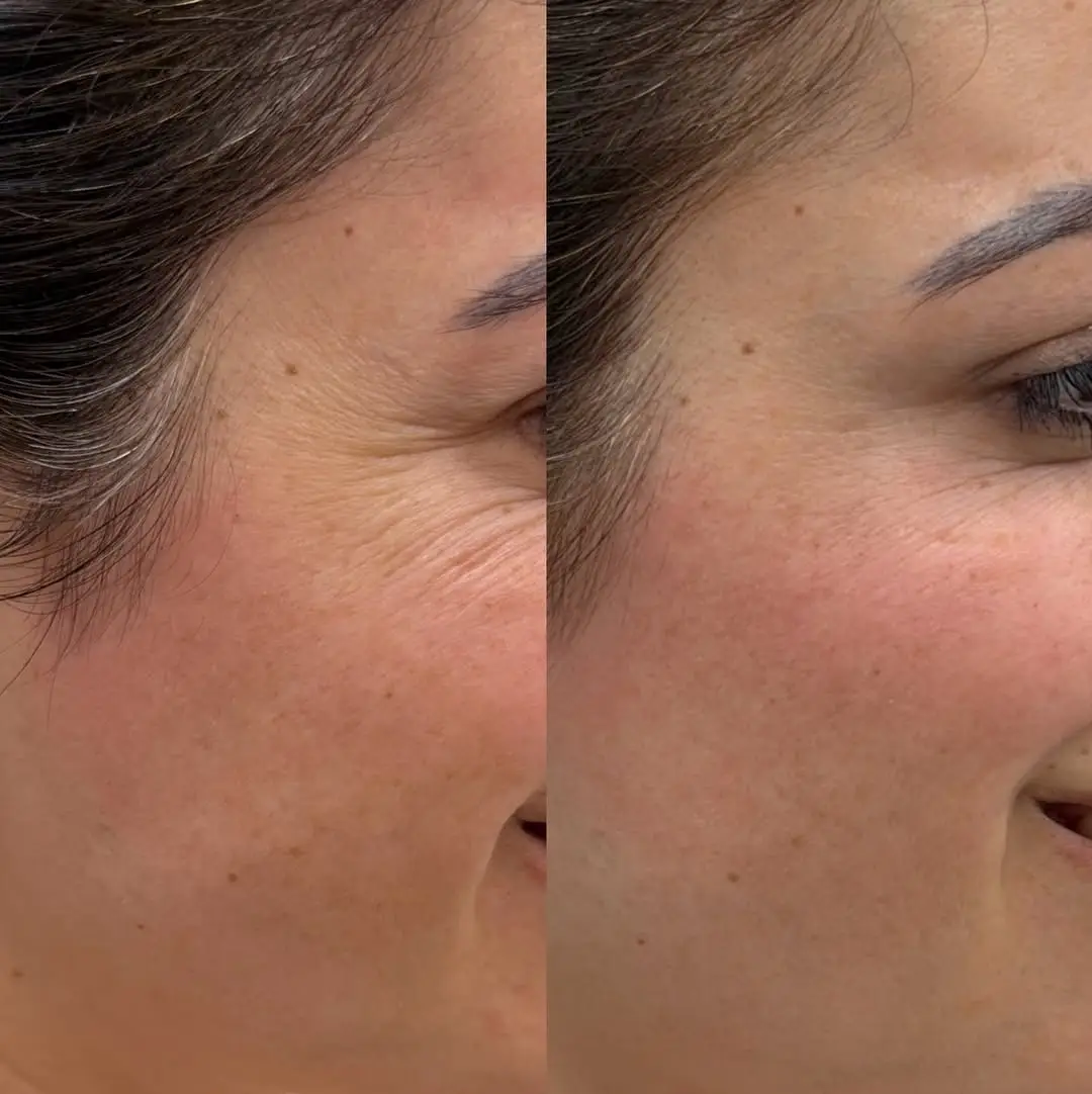 before and after side face Neurotoxins Jenelles Medspa